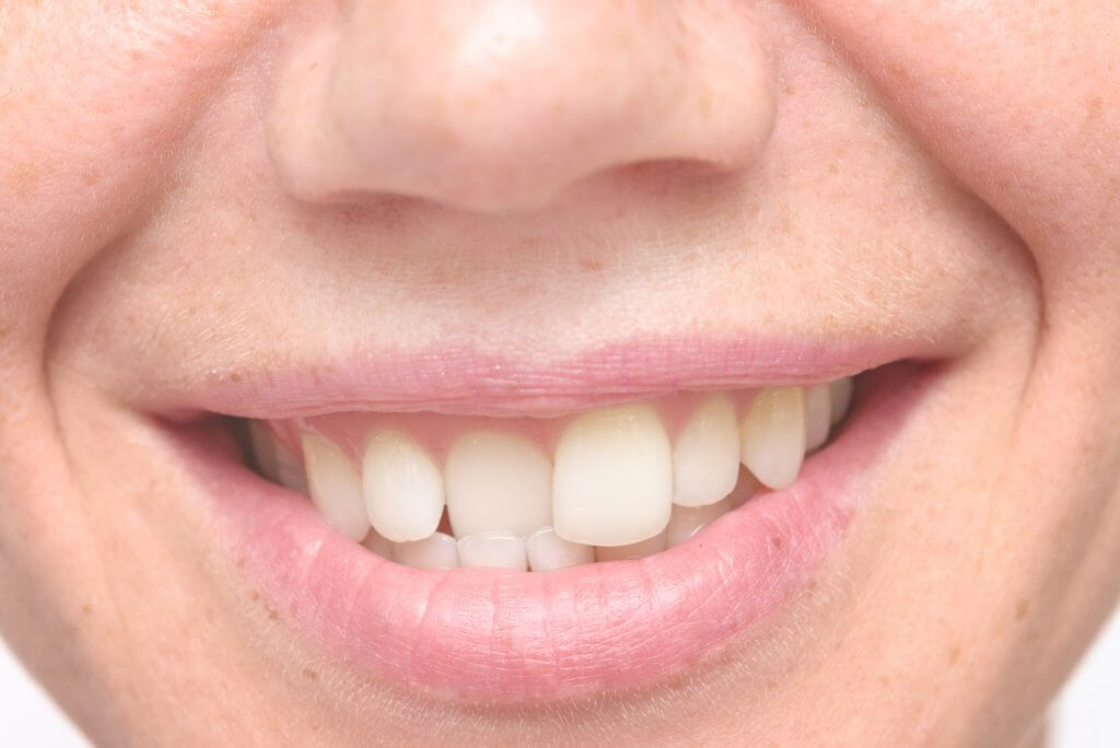 misaligned teeth image of a lady