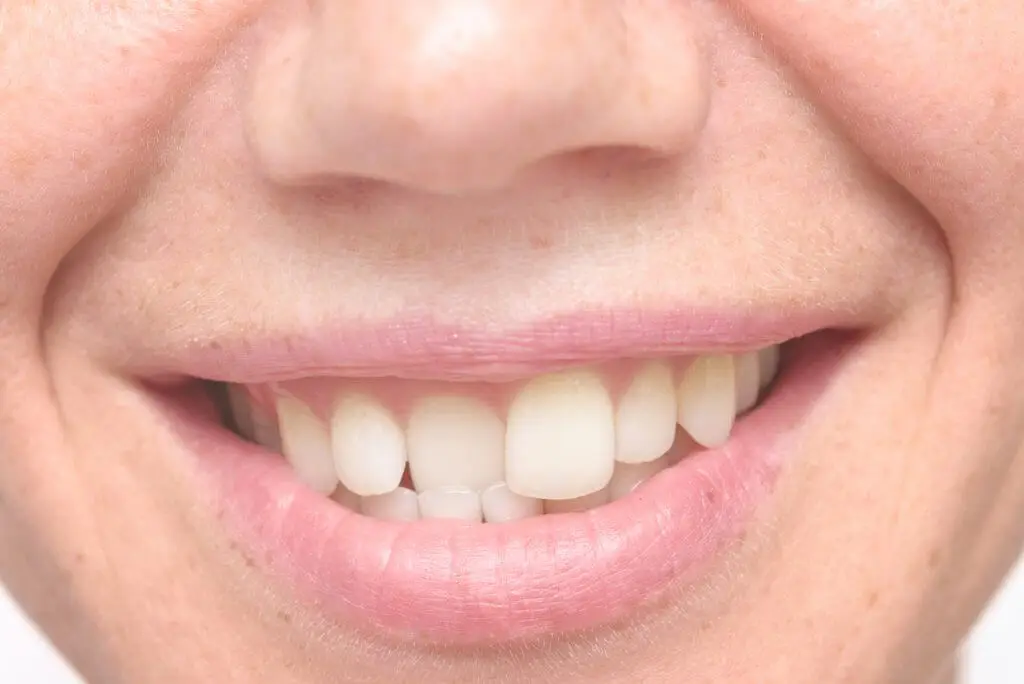 misaligned teeth image of a lady